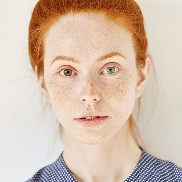 What Do You Know About Heterochromia? - Evolving Eyecare